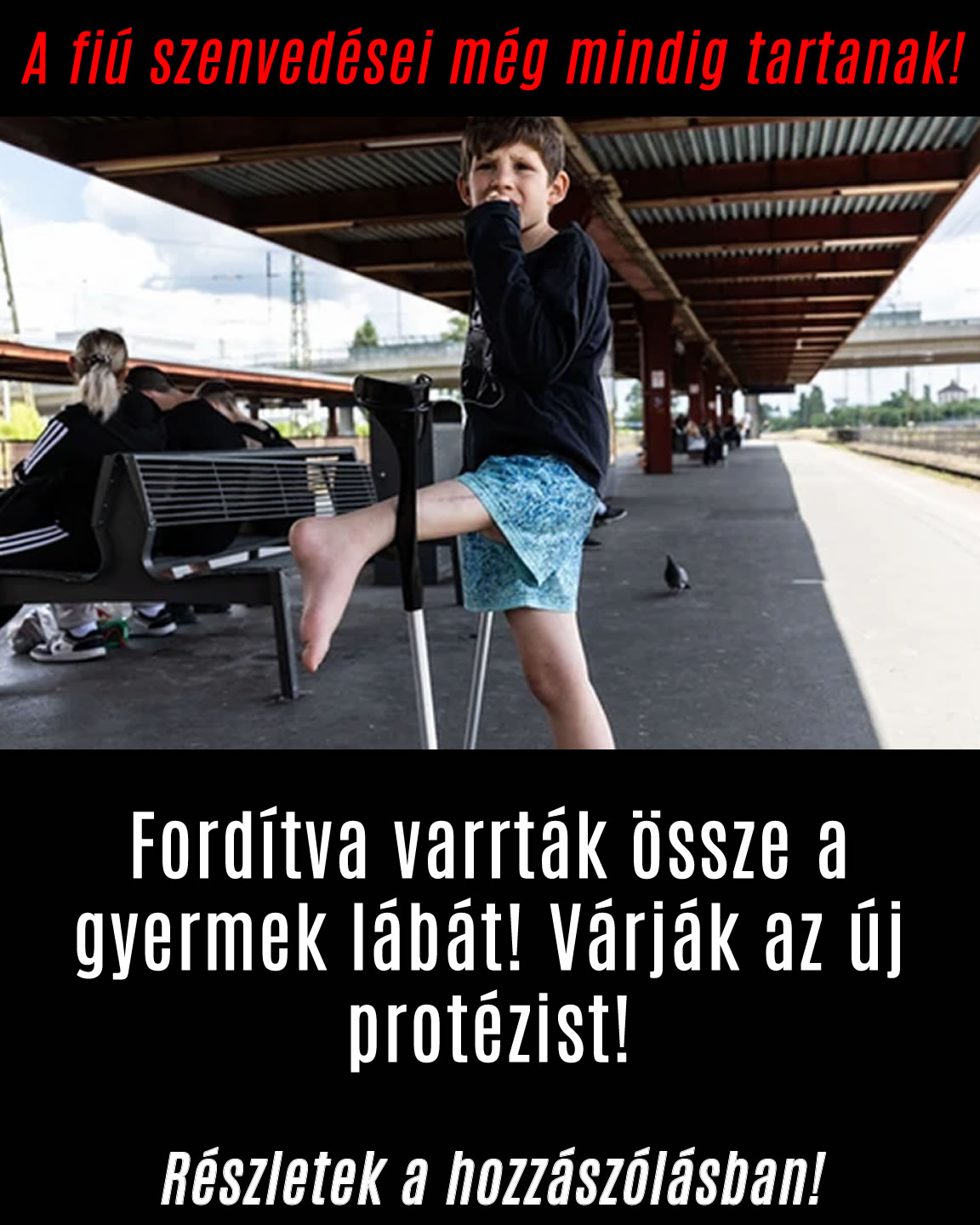 Fordítva varrták össze a gyermek lábát! Várják az új protézist!