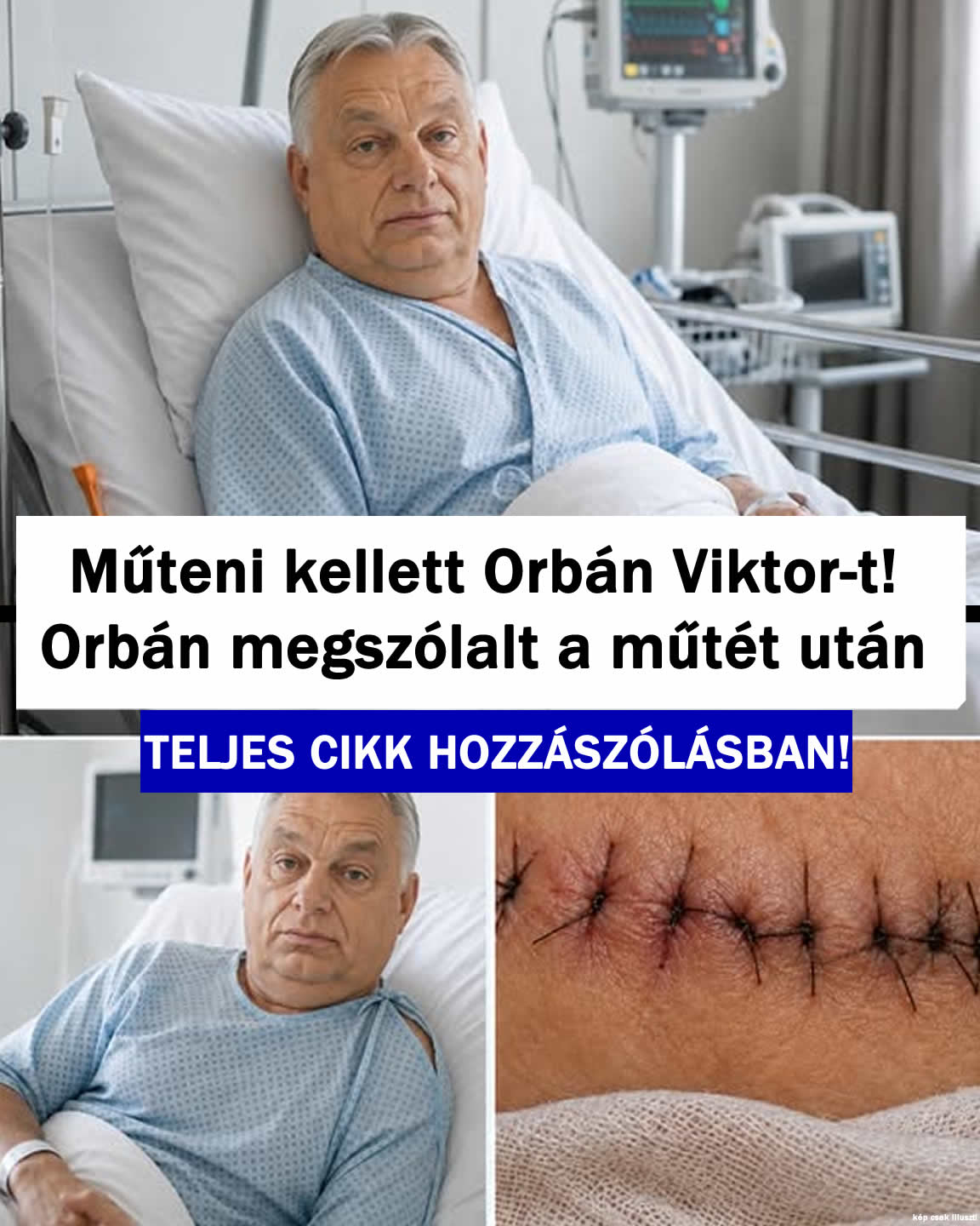 MŰTENI KELLETT! Orbán Viktor megszólalt a műtét után